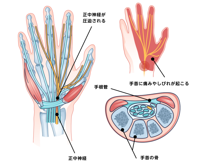 手の指のしびれの原因として、手根管症候群の可能性はありますか？ ｜手の指のしびれ